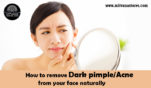 How to remove dark pimple or Acne from your face naturally.